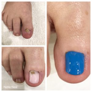 Barefoot toenail restoration
